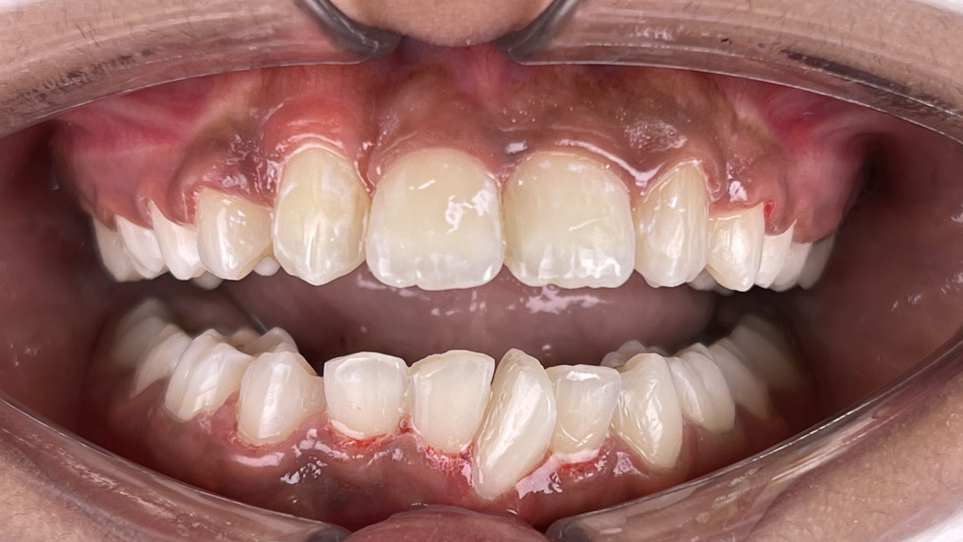 Narrow jaw correction